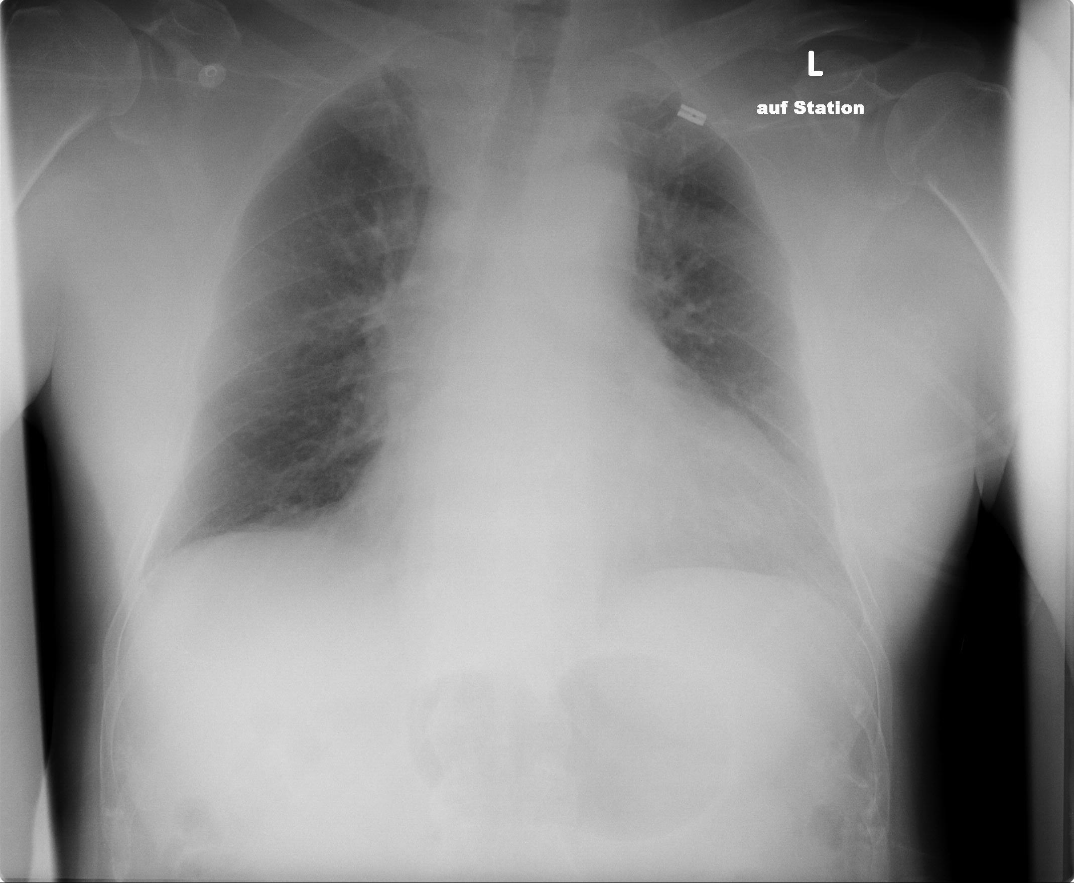 Röntgenbild einer Thorax-PA